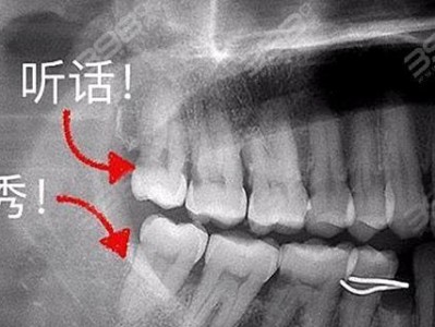 智齿拔除全攻略（了解智齿拔除的注意事项，避免疼痛与并发症）